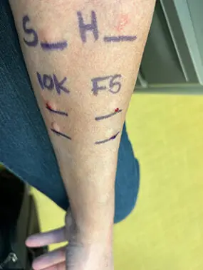 The photo shows a close-up of a man’s left forearm. He’s undergoing allergy testing, so there are various marks and welts indicating what he’s allergic to.