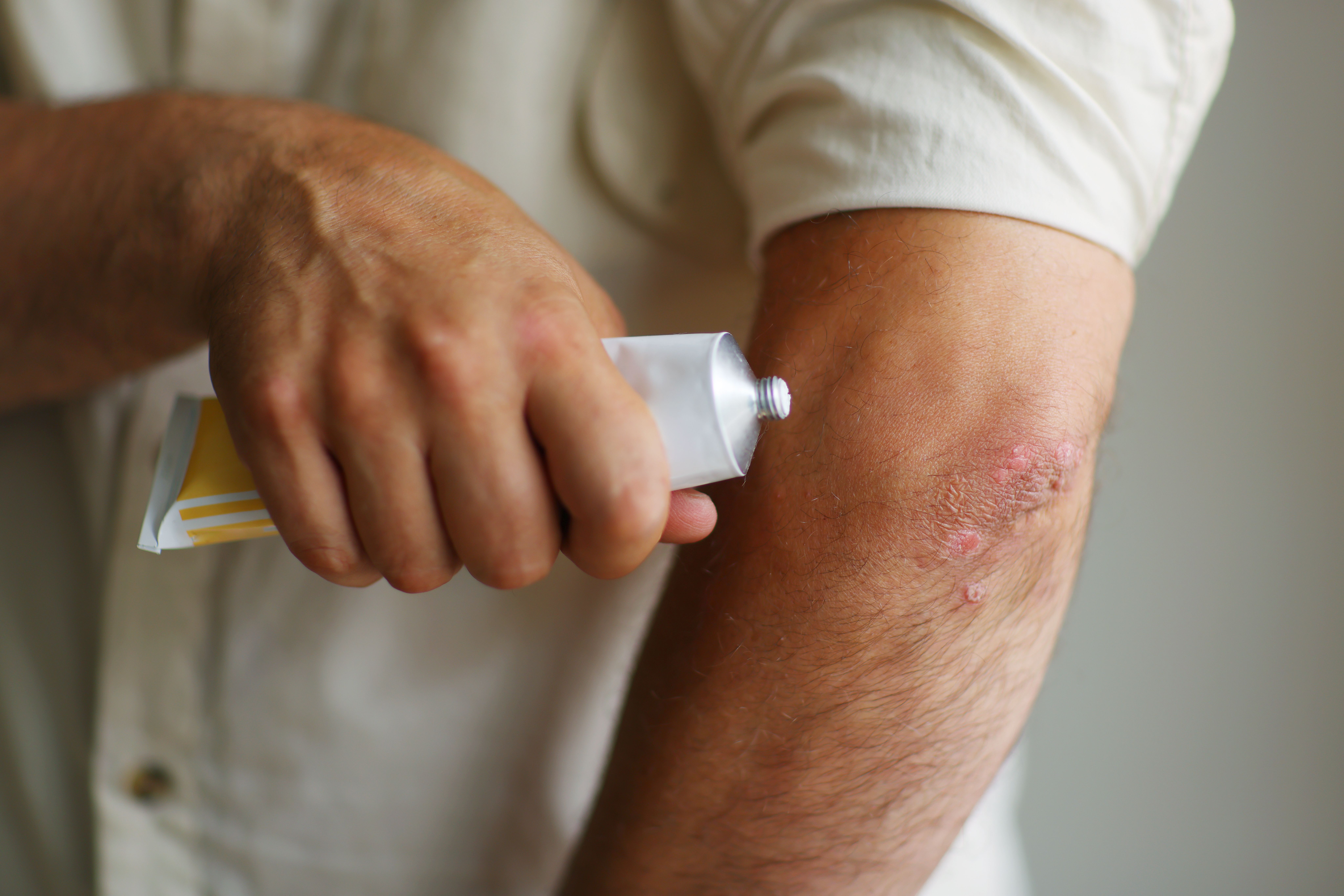 Global Analysis Links Psoriasis Severity to Quality of Life: Insights for Tailored Treatments