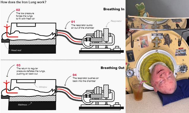 The Enduring Legacy of the Iron Lung in Overcoming Polio Paralysis