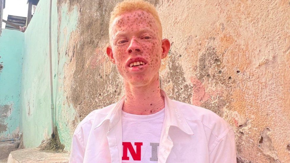 Somalis with albinism: Pelted with stones and raw eggs