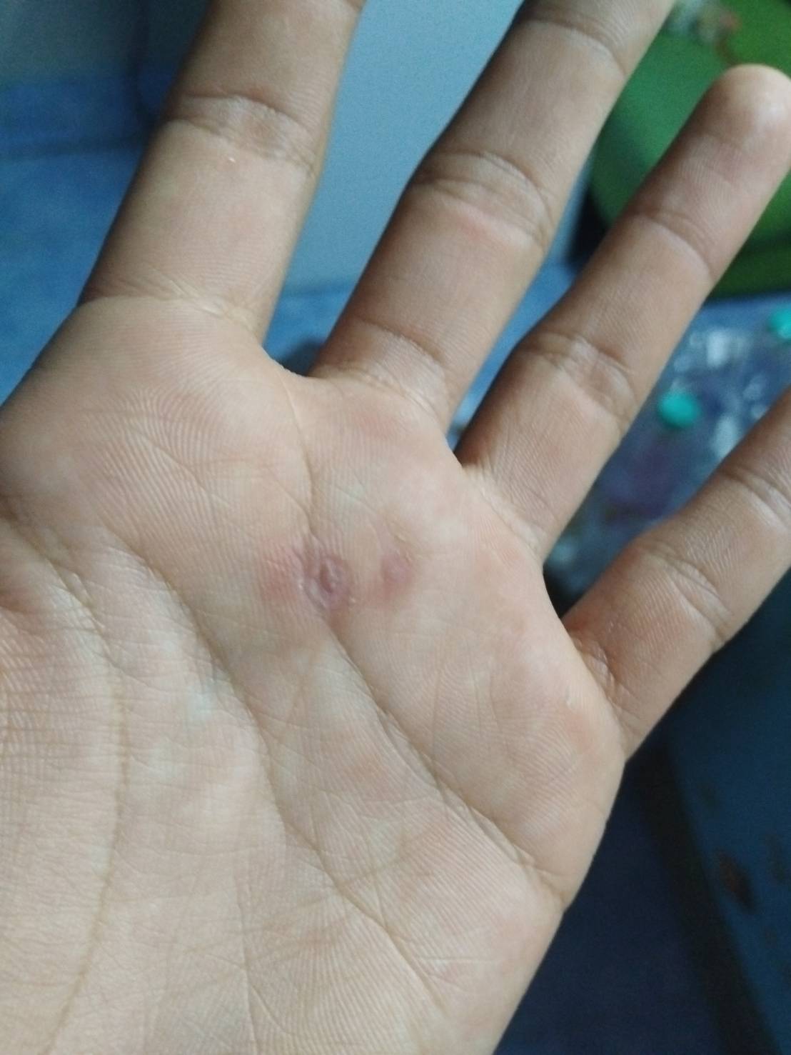 รีวิวรักษาหูด บนฝ่ามือ ที่สถาบันโรคผิวหนัง ราชวิถี