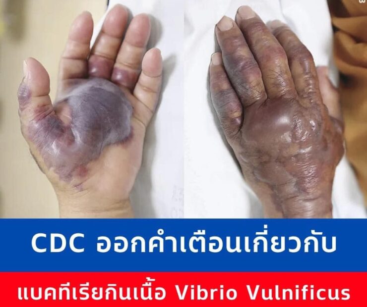 เปิดภาพสะพรึง! ‘แบคทีเรียกินเนื้อ’ ถึงขั้นตาย ย้ำคนชอบเล่นน้ำ-กินอาหารทะเลระวังให้ดี
