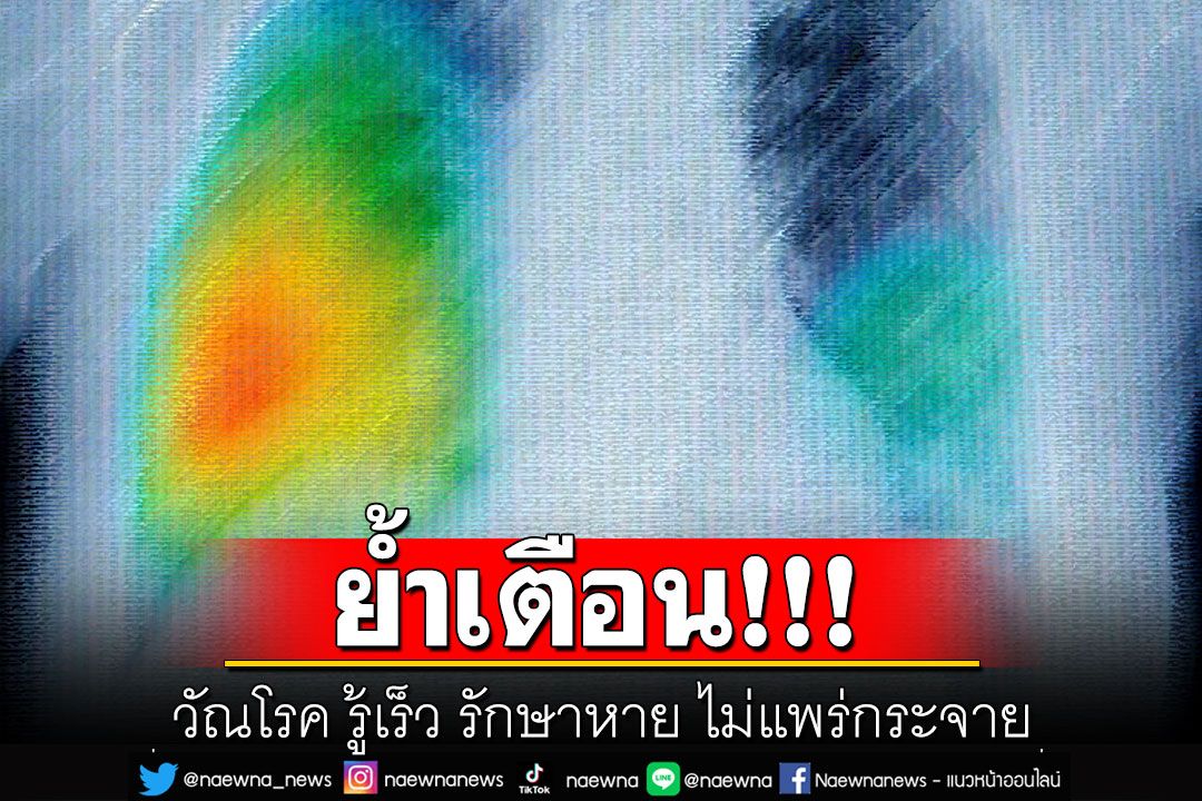 ย้ำเตือน! ‘วัณโรค รู้เร็ว รักษาหาย ไม่แพร่กระจาย ผู้สัมผัสควรรีบตรวจ เพื่อเข้าสู่ขบวนการรักษา
