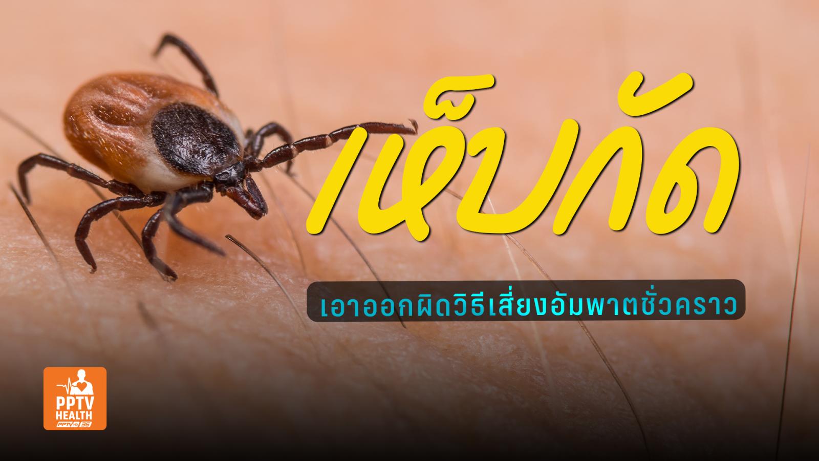 “เห็บกัด” ดึงออกผิดวิธีอาจเสี่ยงอัมพาตชั่วคราวหัวใจล้มเหลว