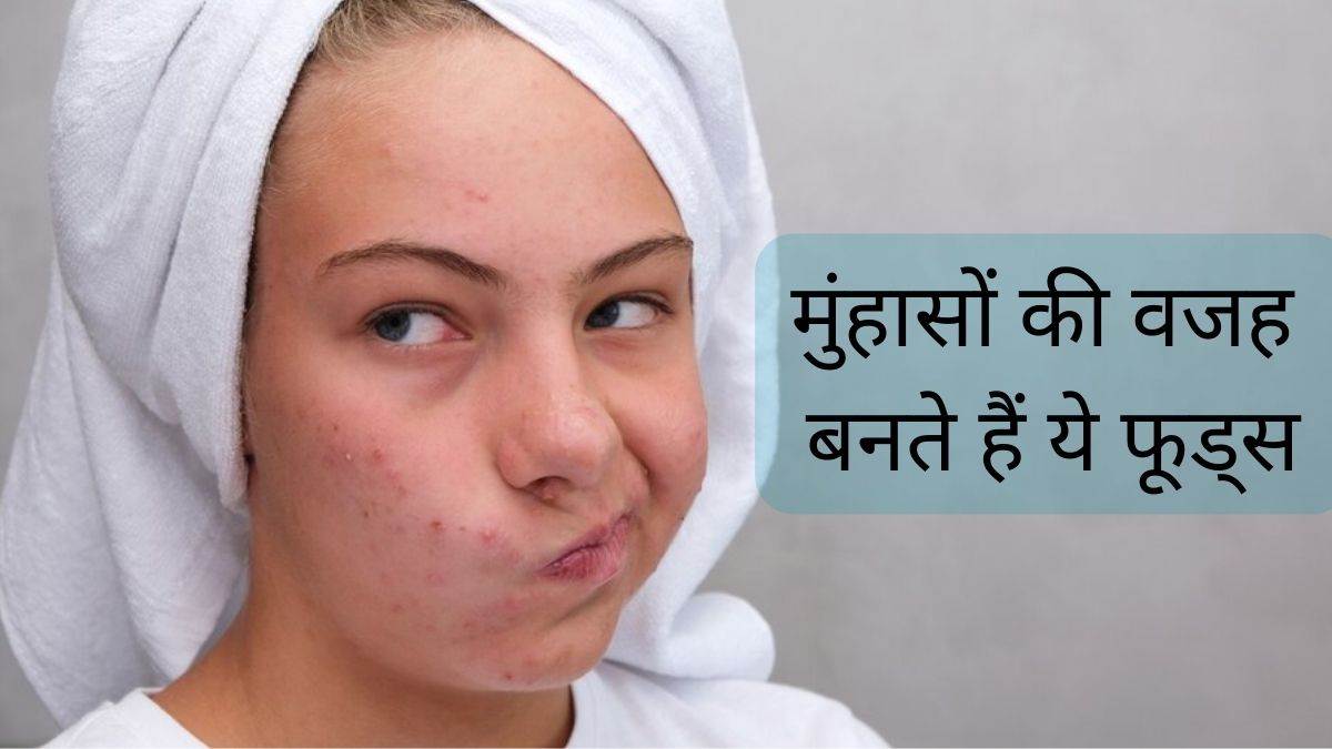 Acne Causing Foods: मुंहासों की वजह बन सकते हैं ये फूड आइटम्स, बेदाग त्वचा के लिए आज ही बनाएं इनसे दूरी – Acne Causing Foods these 5 foods items can cause pimples in skin