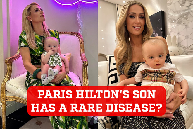 What is the cause of macrocephaly? The rare disease that many say Paris Hilton’s son has