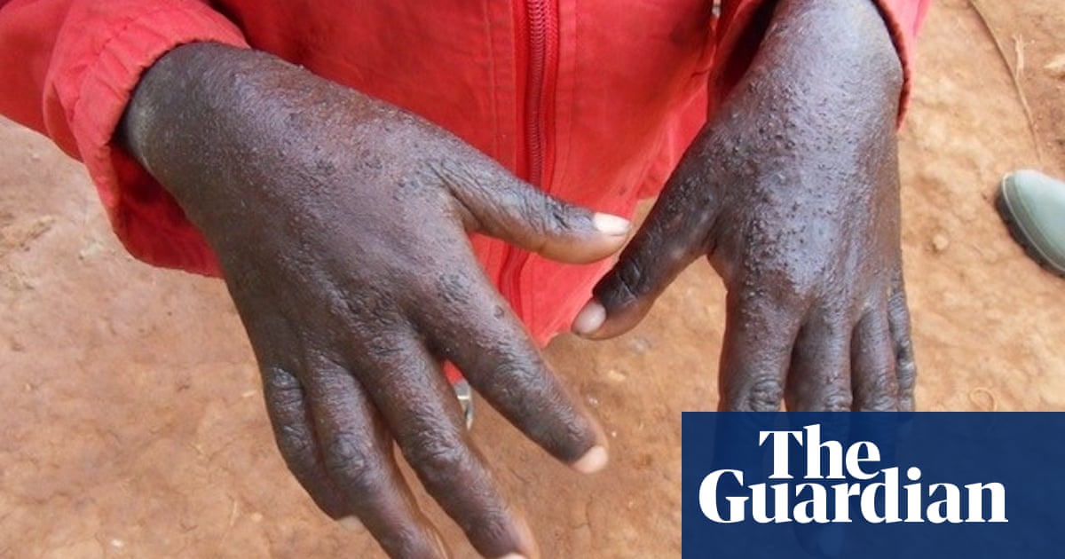 Malawi battles outbreak of scabies that health experts link to climate crisis