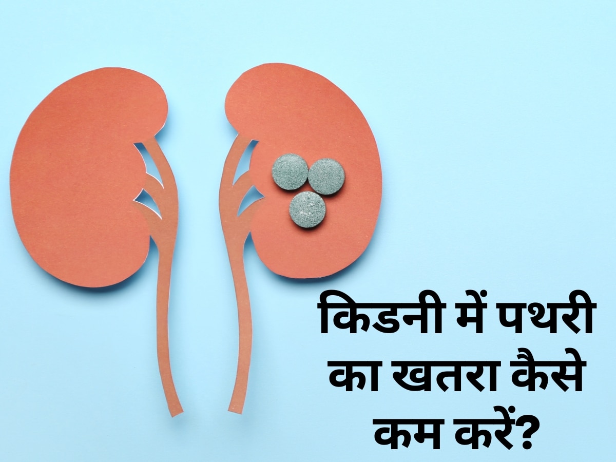 Kidney Stone: किडनी में पथरी का खतरा बढ़ाते हैं ये 5 फूड, गलती से भी न करें इन चीजों का सेवन