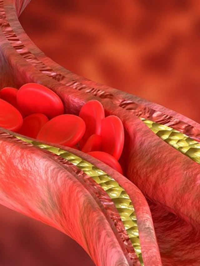 शरीर में बैड कोलेस्ट्रोल का पहाड़ बनाती हैं ये 8 चीजें, हार्ट अटैक का देती हैं वॉर्निंग साइन