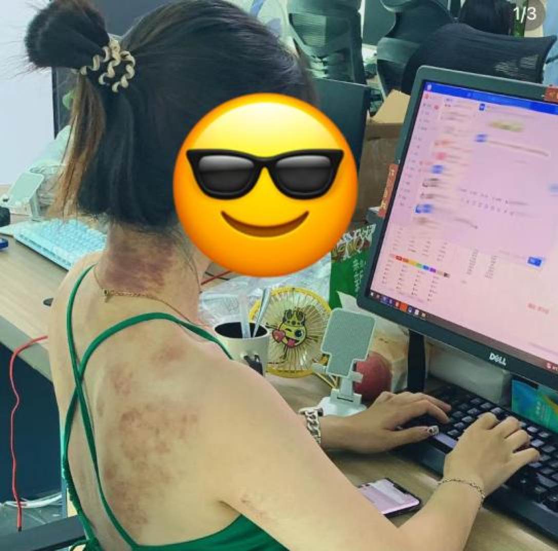 From blotchy bruises to fashion fad: China youth make traditional treatment vogue