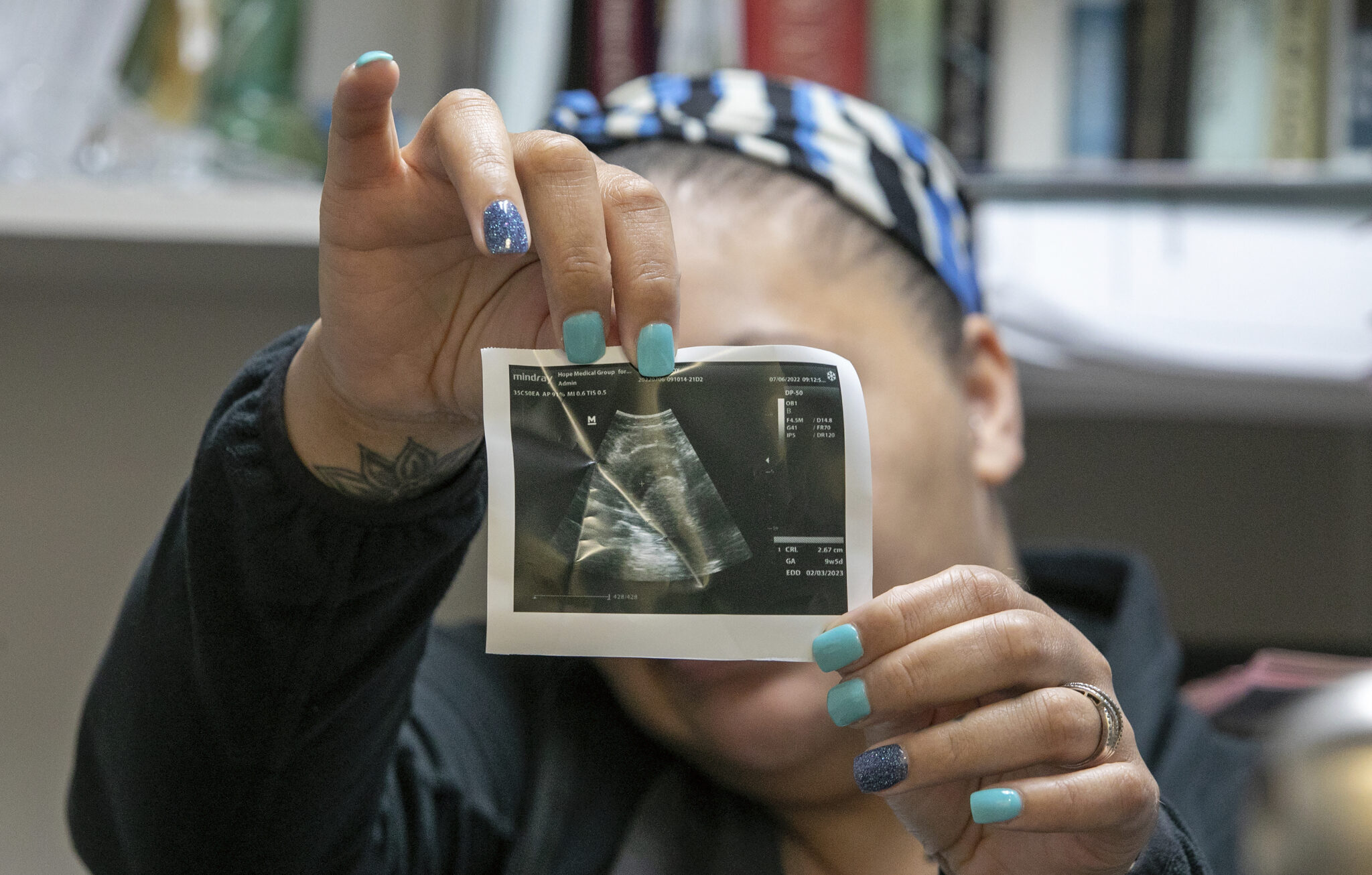 Medical exceptions to abortion bans often exclude mental health conditions