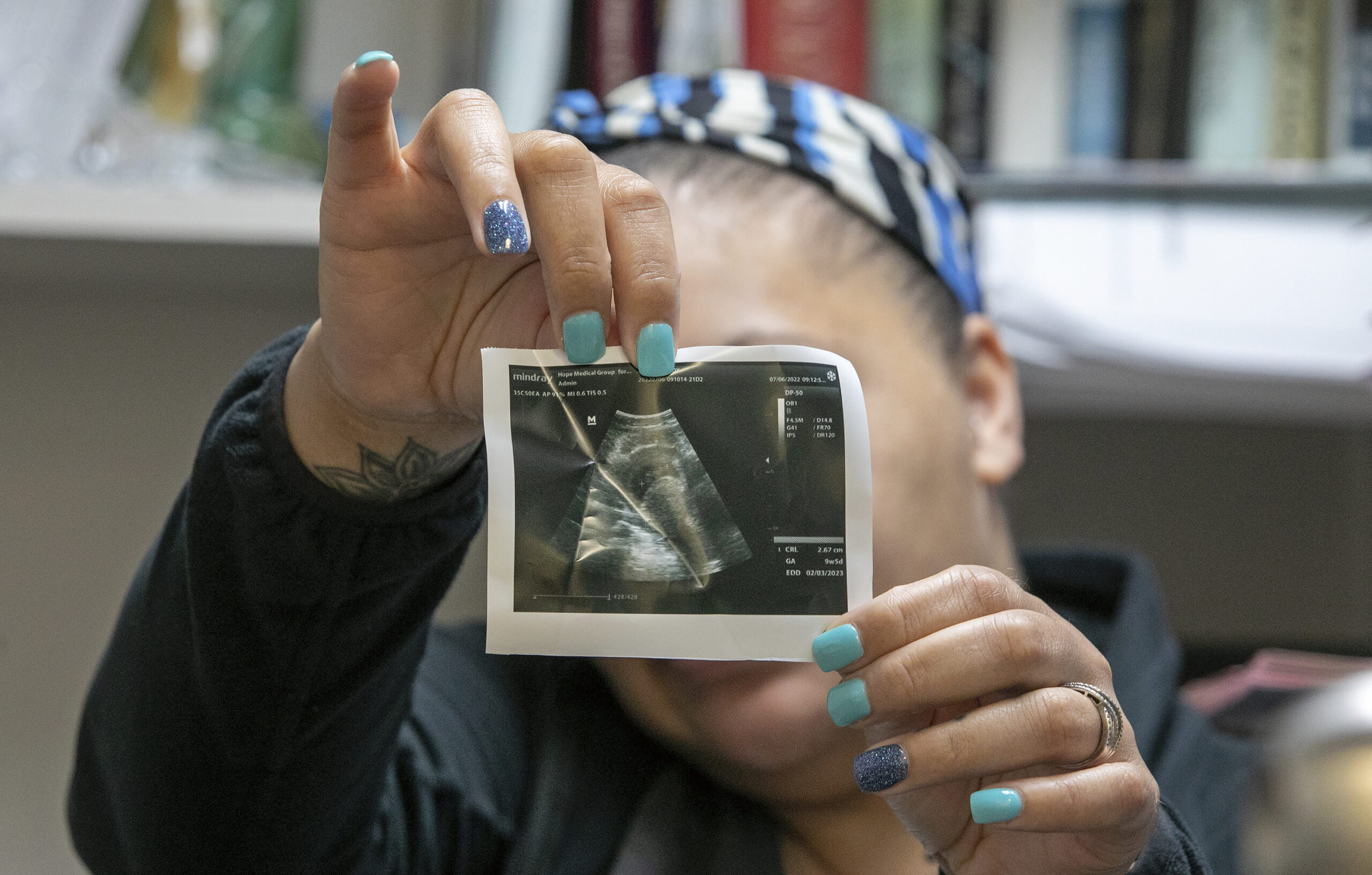 Medical exceptions to abortion bans often exclude mental health conditions