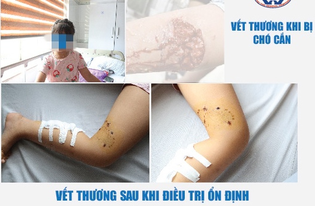 Bị chó nhà hàng xóm cắn, bé trai điều trị cả tháng vết thương chưa liền