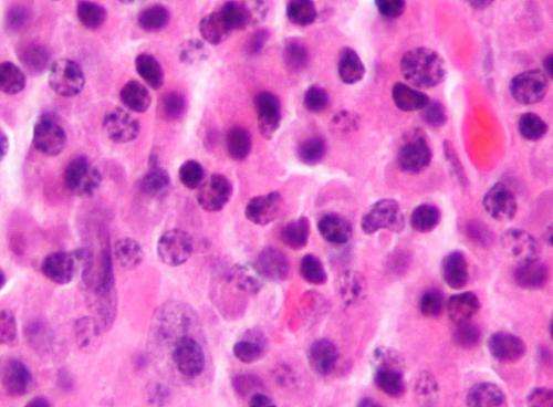 CAR T-cell therapy effective in patients with blood cancer regardless of race: Study