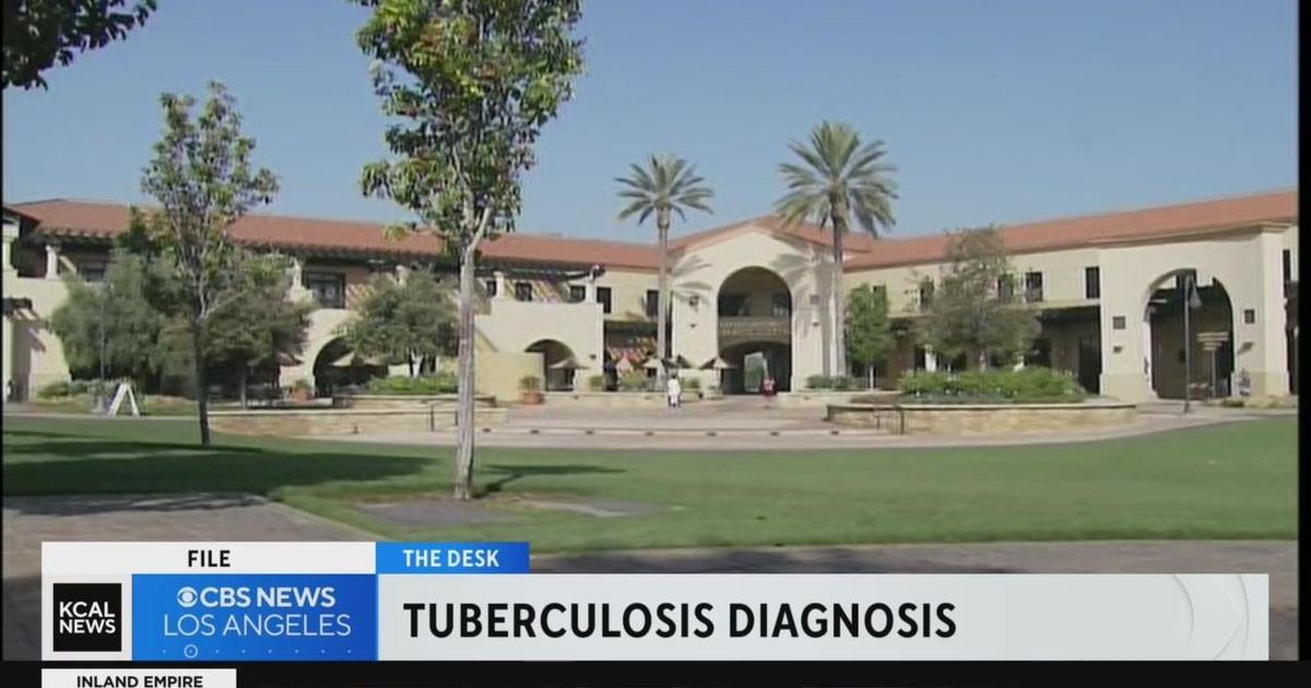 Riverside County resident tests positive for tuberculosis, according to health officials