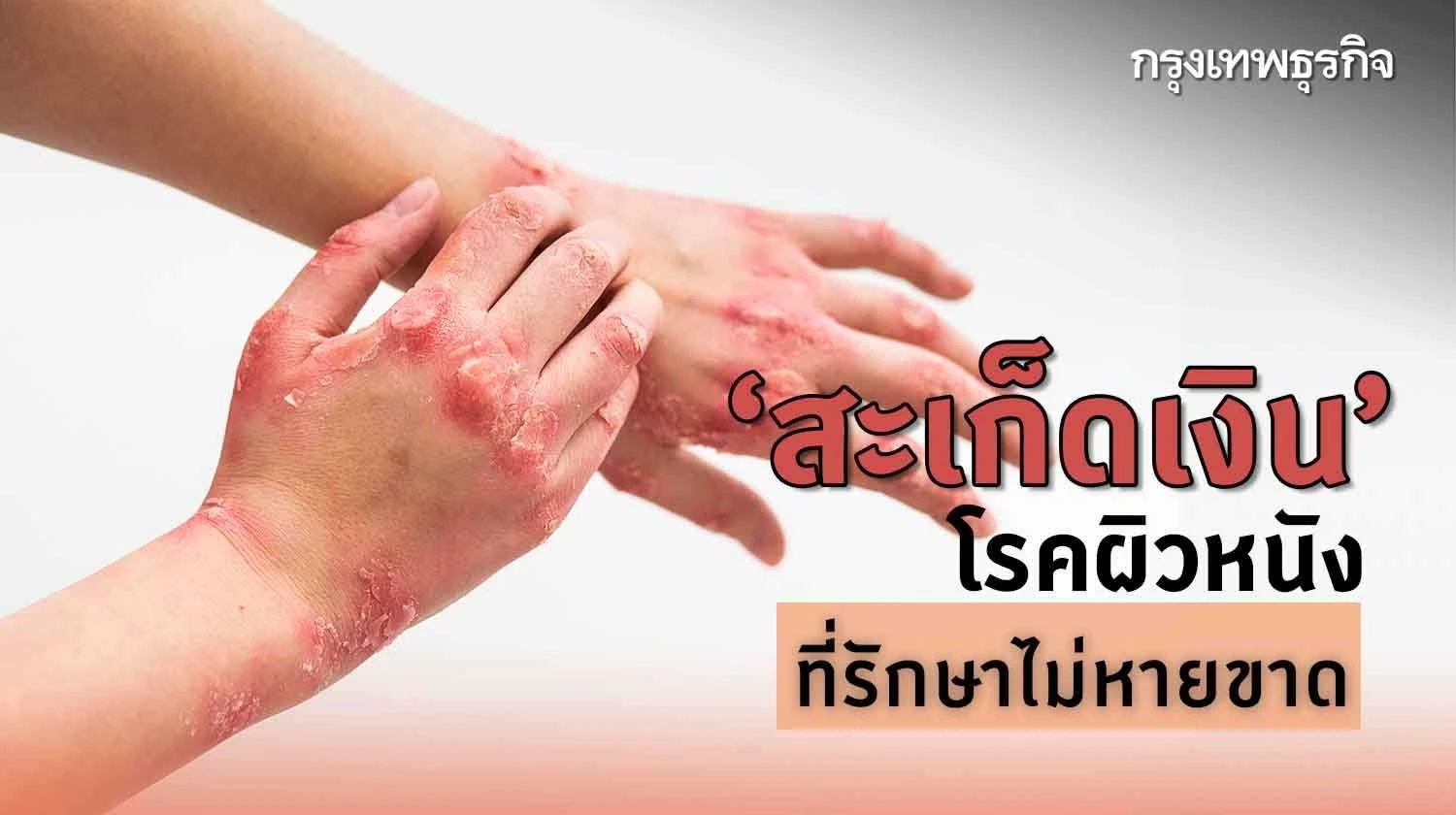 ‘สะเก็ดเงิน’ รักษา-ดูแลตัวเองอย่างไร เมื่อโรคไม่หายขาด