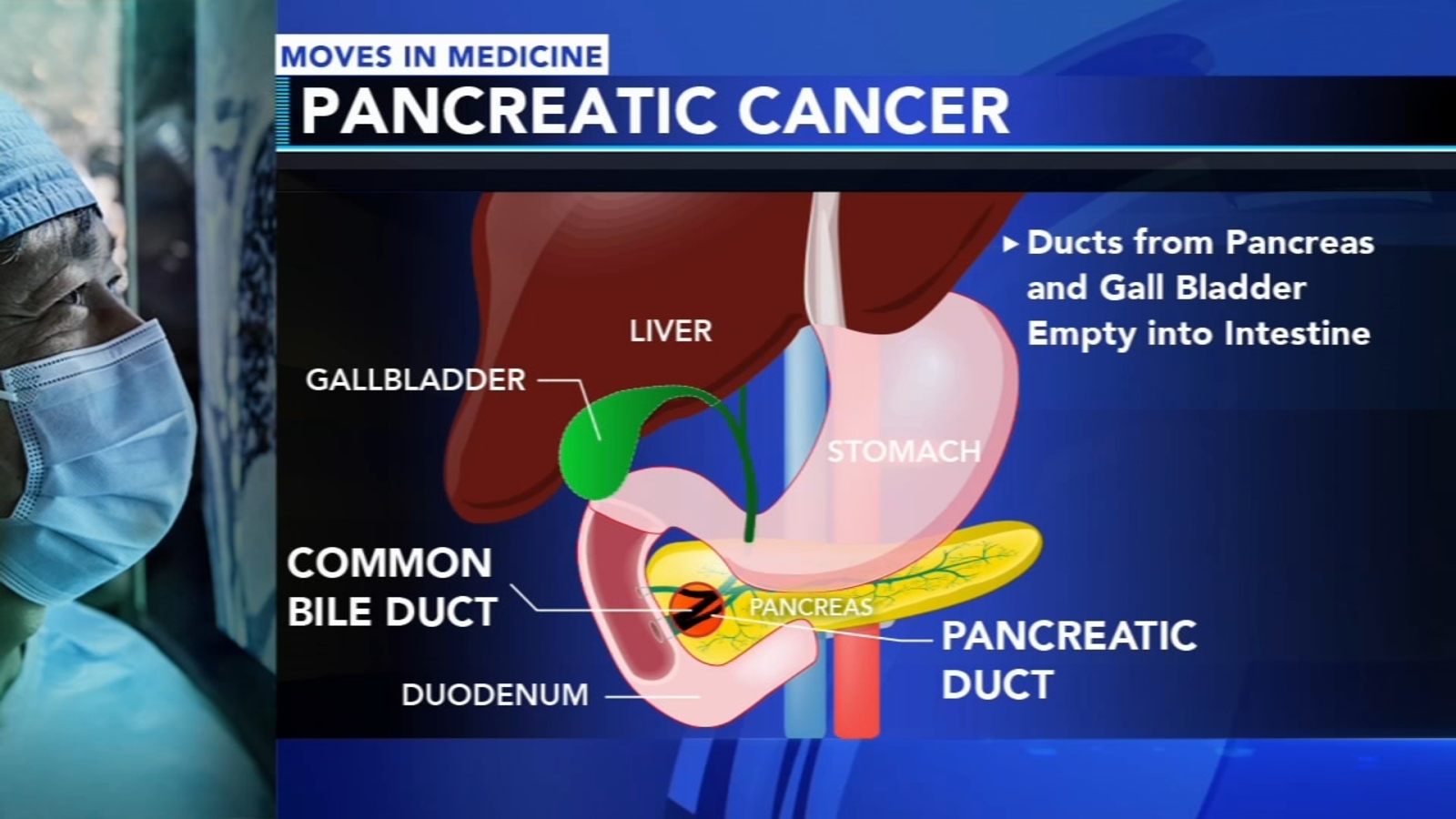 New study looks at environment and pancreatic cancer – around the person and tumor