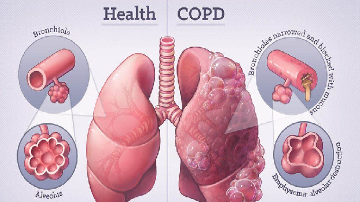 Delhi News: दिल्ली में हर सातवां ऑटो चालक COPD से पीड़ित, खतरनाक है अंजाम; ऐसे करें बचाव – Delhi News Every seventh auto driver in Delhi is suffering from COPD