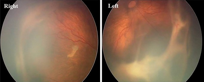 The effect of leucocytosis on retinopathy of prematurity