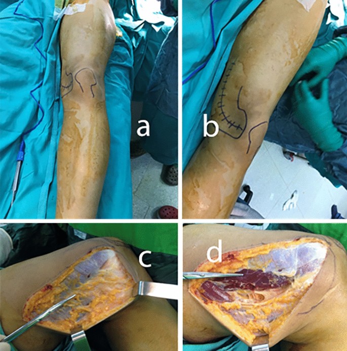 Treatment of recalcitrant femur nonunion with pedicled corticoperiosteal medial femoral condyle flap