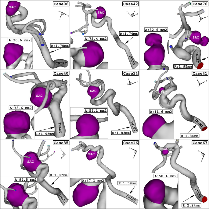 Computational and statistical analyses of blood hemodynamic inside cerebral aneurysms for treatment evaluation of endovascular coiling