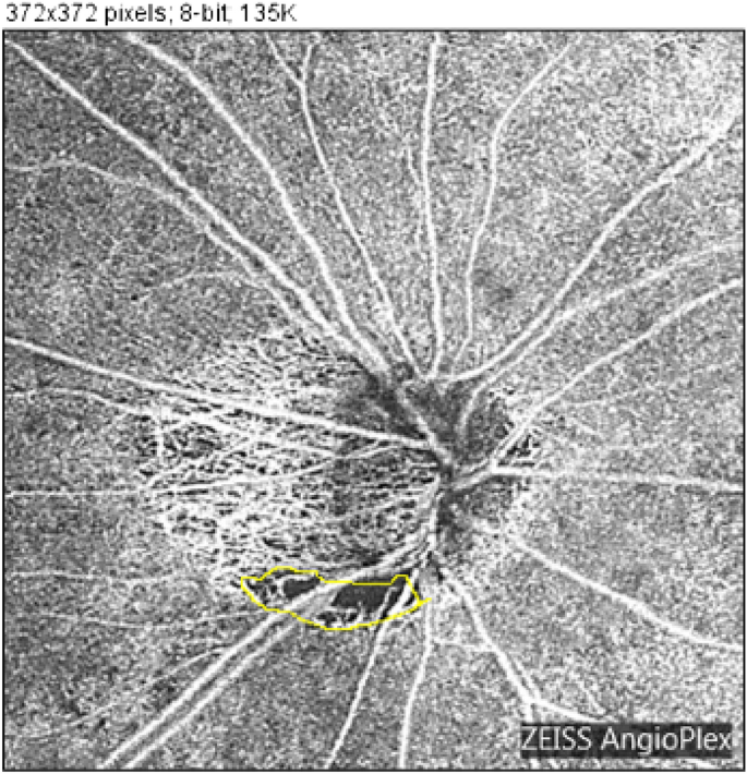 Parapapillary choroidal microvasculature dropout in eyes with primary open-angle glaucoma