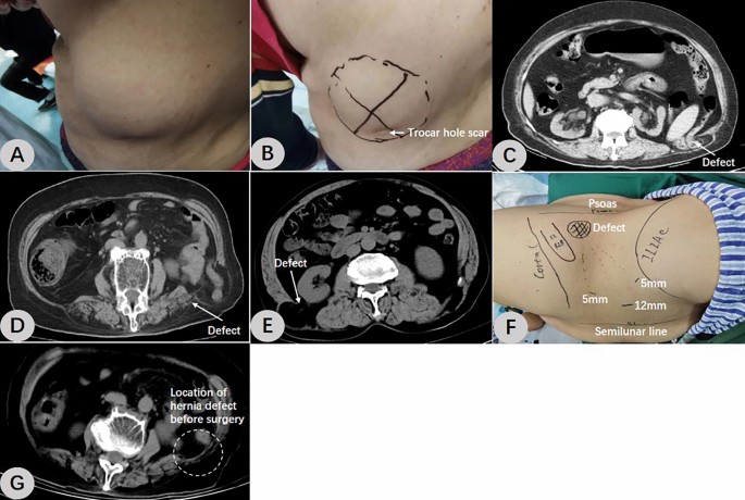 Retroperitoneal totally endoscopic prosthetic repair of lumbar hernia