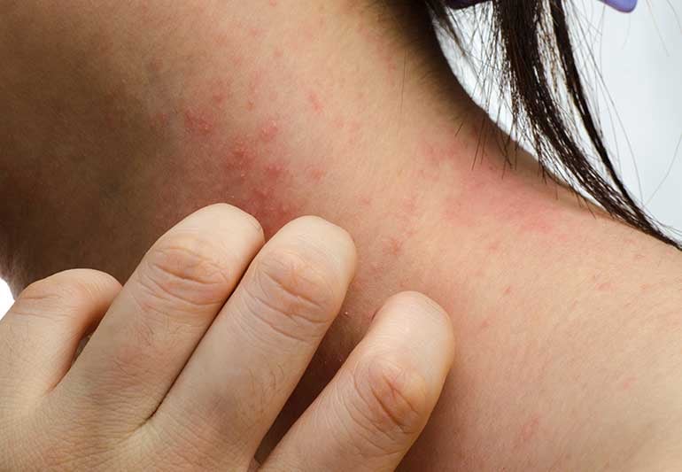How Lifestyle Changes and Self-Care Can Improve Your Eczema
