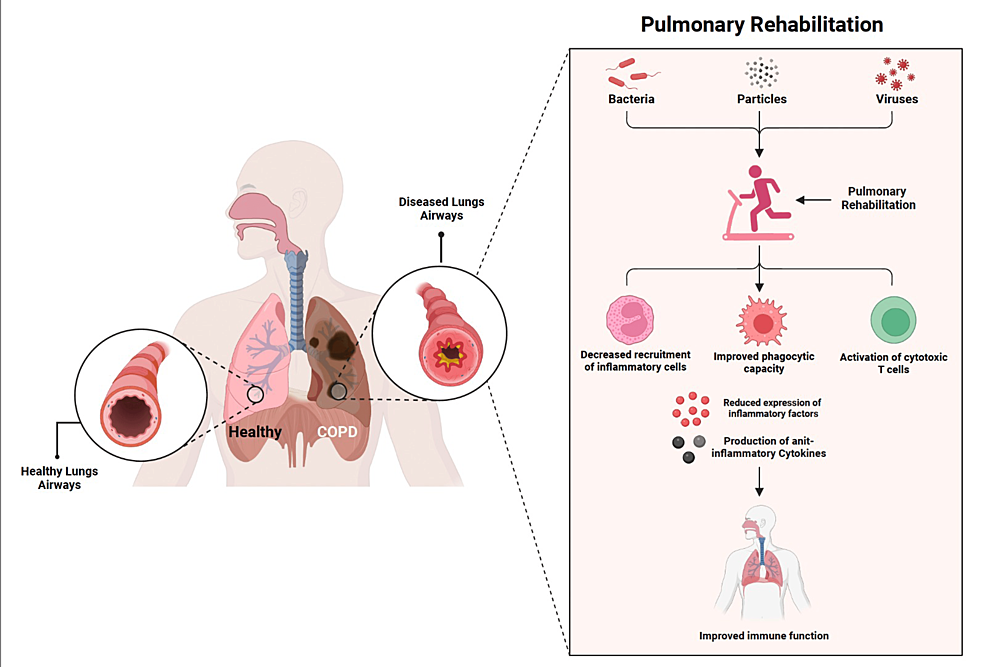 The Impact of Pulmonary Rehabilitation on Mental Health and Quality of Life in Patients With Chronic Obstructive Pulmonary Disease (COPD): A Narrative Review