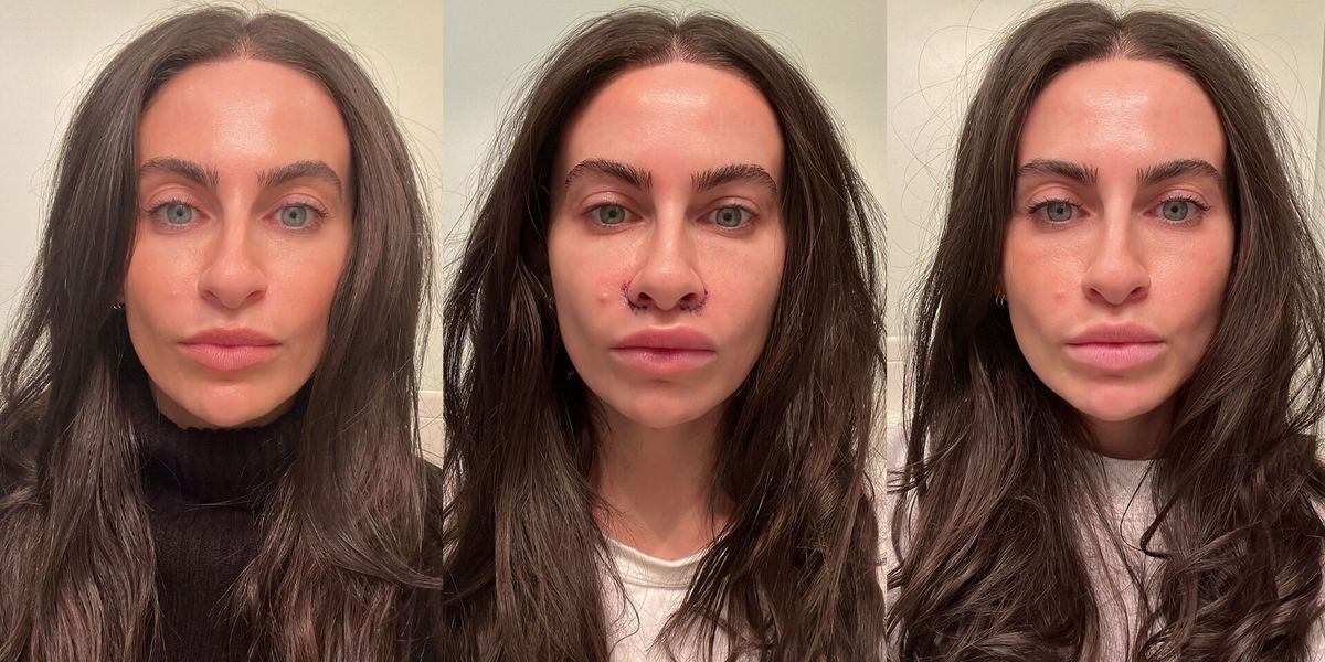 I Got a Lip Lift and Didn’t Love the Results — So I Went Back Under the Knife Again