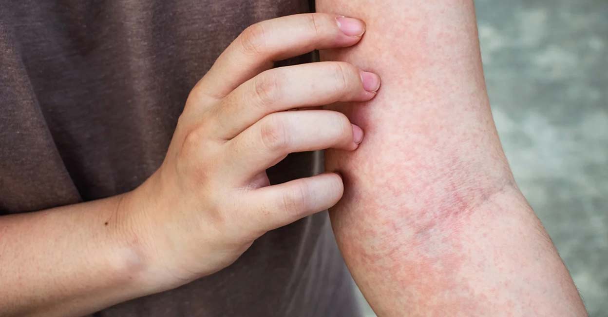 Common microbe that causes persistent itching in conditions like eczema identified