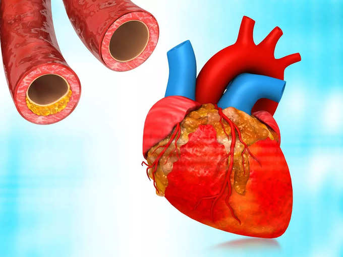 कोलेस्ट्रॉल से मरने की आ गई थी नौबत, महिला ने बिना दवा 4 तरीकों से कम किया Bad cholesterol