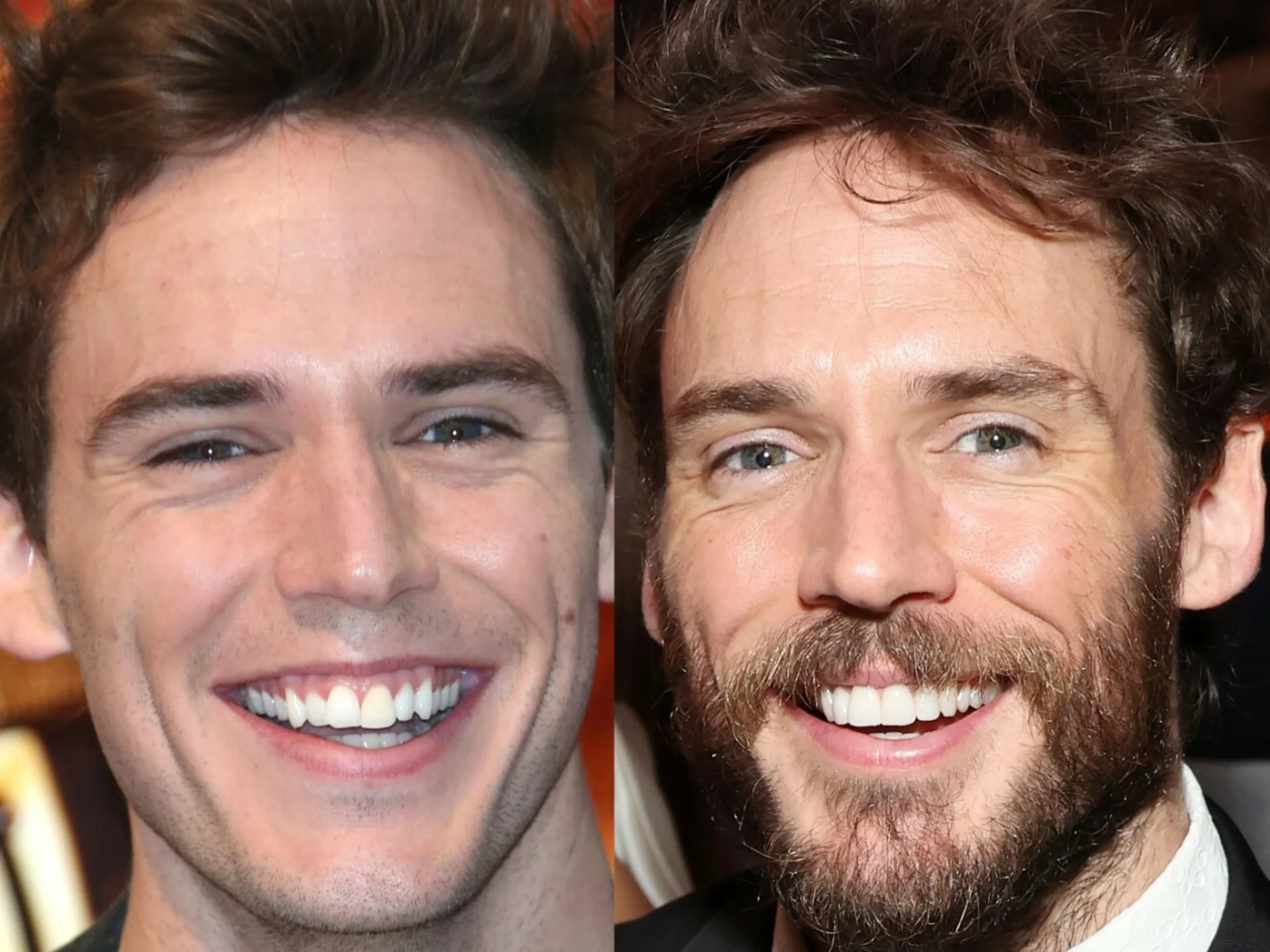 Did Sam Claflin Get Veneers? Here Are 14 Celebrities Before And After Veneers