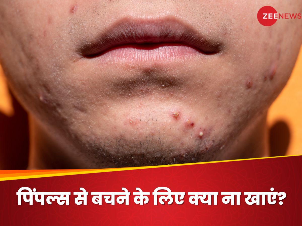 Acne Causes: चेहरे पर मुंहासे की वजह बनते हैं 5 फूड, डाइट से तुरंत हटा दीजिए इन्हें