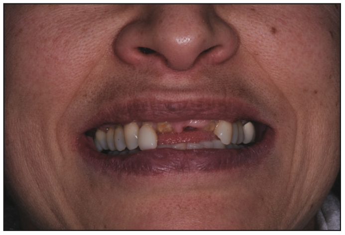 A Complex Dental Restoration Using Cutting-Edge Technology and a Patient-Centric Approach