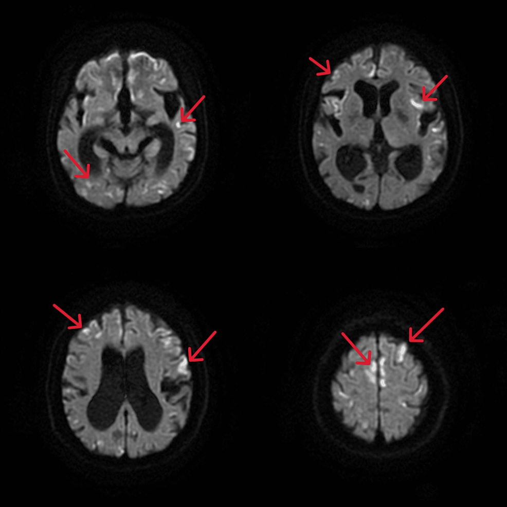 Improvement of Intestinal Pseudo-Obstruction by Total Parenteral Nutrition in a Young Woman With Mitochondrial Myopathy, Encephalopathy, Lactic Acidosis, and Stroke-Like Episodes: A Case Report