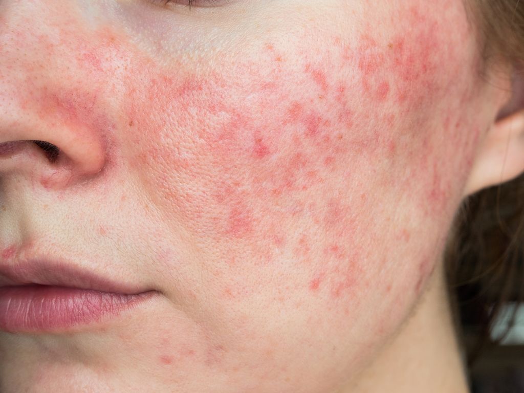 I struggle with rosacea – here’s how I manage it