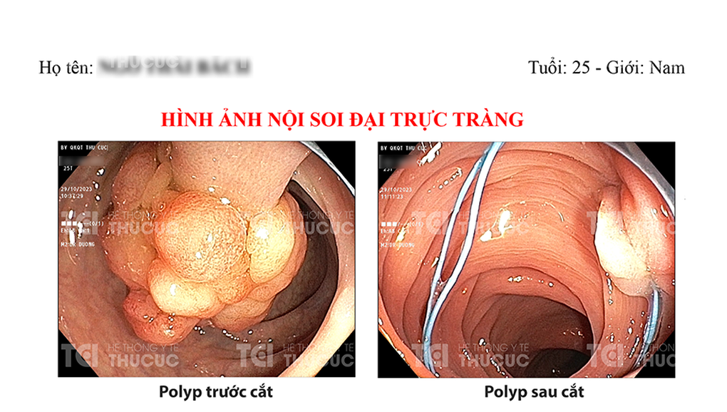 Chàng trai 25 tuổi ôm “quả bom nổ chậm” 4cm trong lòng đại tràng