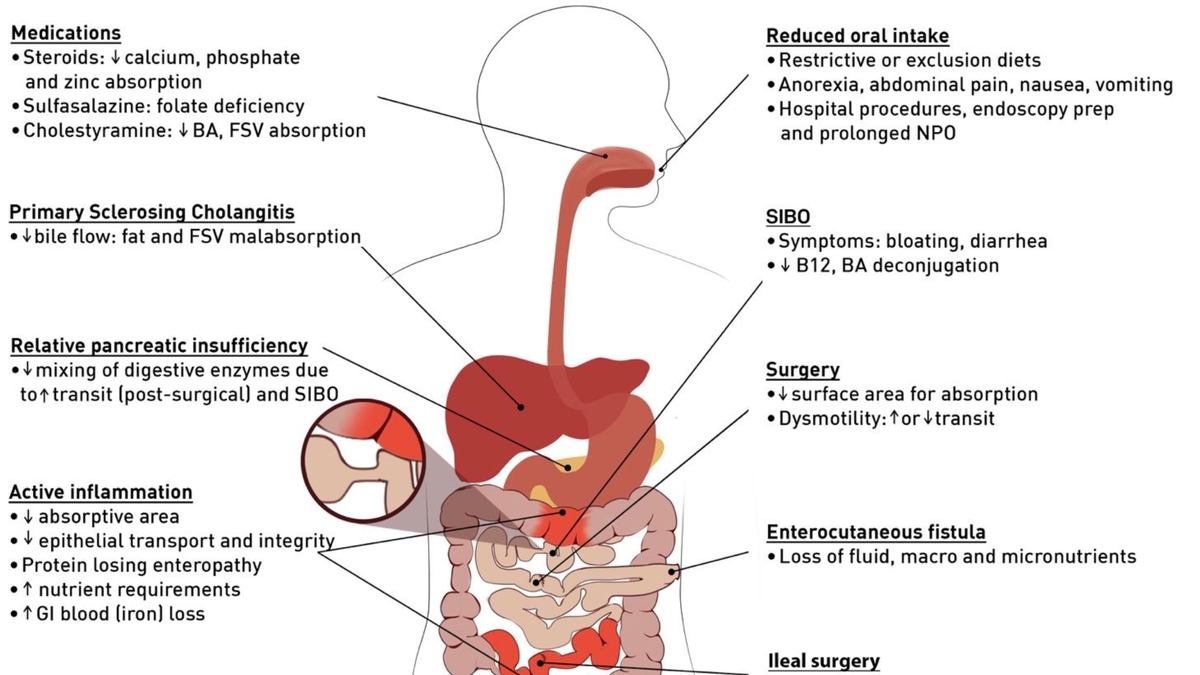 Malnutrition Prevalence in IBD Patients: Study Highlights Importance of Nutritional Support