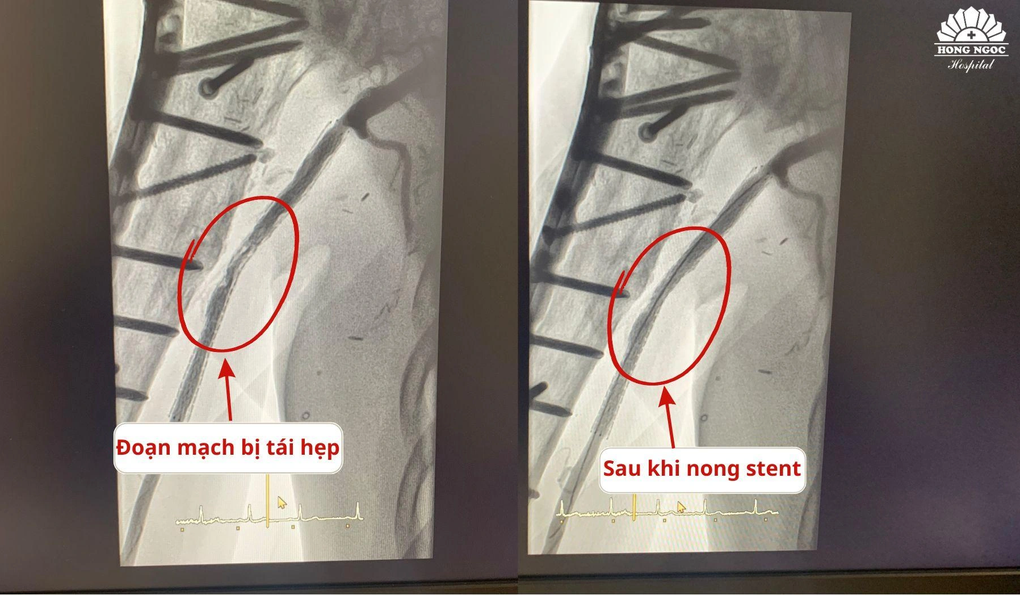 Nong stent hẹp 99% ở cánh tay bệnh nhân đang cố định hàng chục chiếc đinh