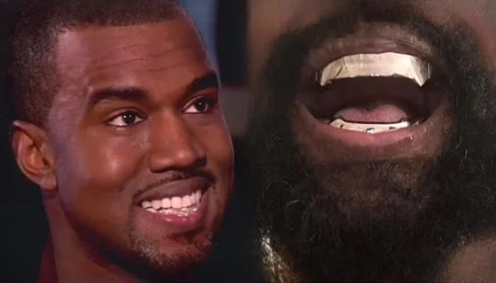 Kanye West Made a ‘Bold’ Decision by Having All Teeth Removed