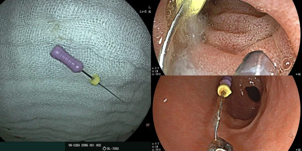 Cháu bé 5 tuổi nuốt cả cây kim nha khoa vào bụng - 1