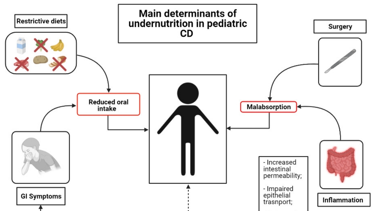 Early Life Diet Quality and Its Impact on Inflammatory Bowel Disease Risk