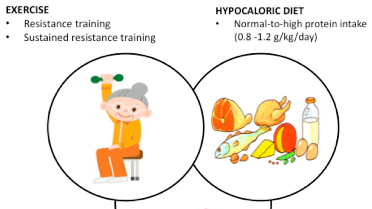 Understanding and Managing Sarcopenic Obesity: Insights and Strategies