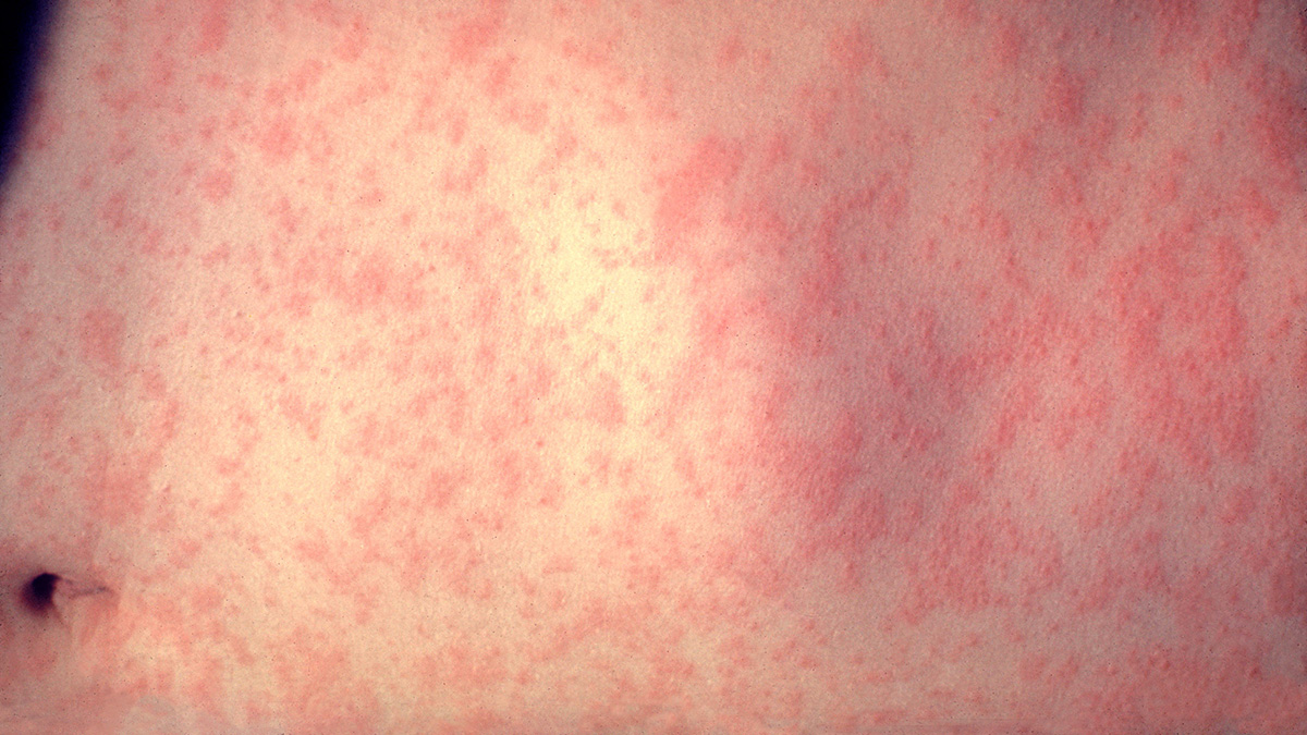 Florida’s Department of Health issues a Measles health advisory in Broward County