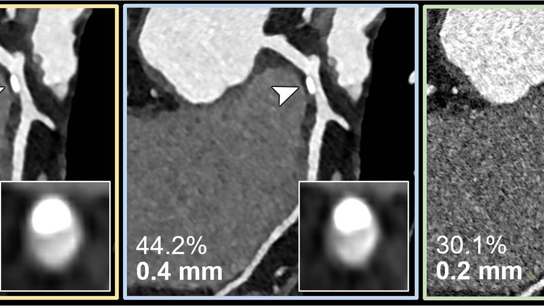 Revolutionizing Coronary Artery Disease Assessment with PCD-CT Technology