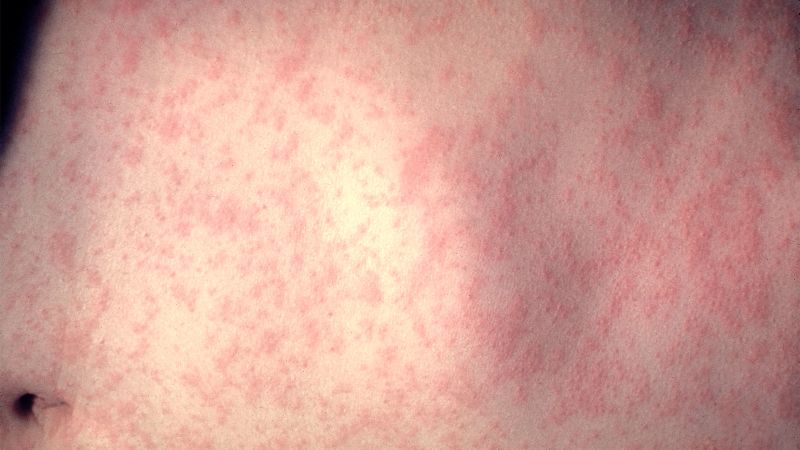 CDC team to help Chicago officials with response to measles outbreak