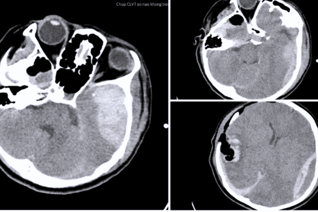 Bác sĩ mổ não 2 lần liên tục, cứu cô gái 23 tuổi “không còn nhiều hy vọng”