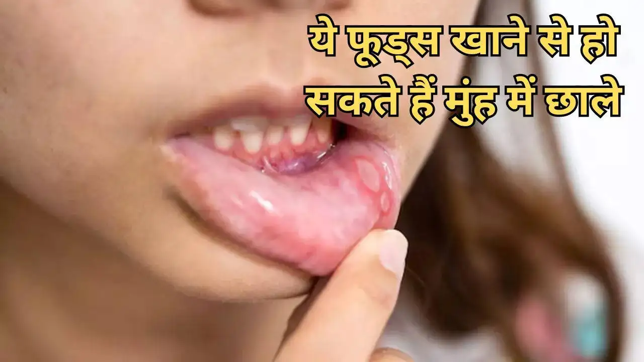 Foods That Cause Mouth Ulcers