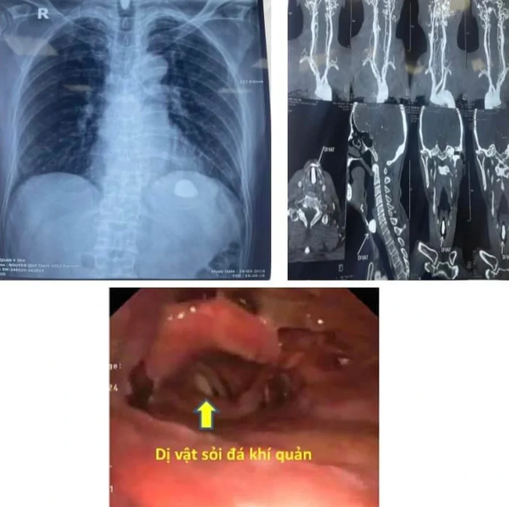 Đang chăm hoa, người đàn ông Hà Nội bỗng bị viên sỏi lọt vào đường thở - 1